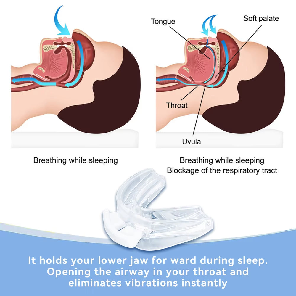 Adjustable Bruxism Mouth Guard and Anti-Snoring Device for Improved Sleep Quality